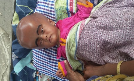 বিরল আকৃতির মাথা, শিশু ময়নাকে বাঁচাতে সবাই সাহায্যর হাত বাড়িয়ে দিন