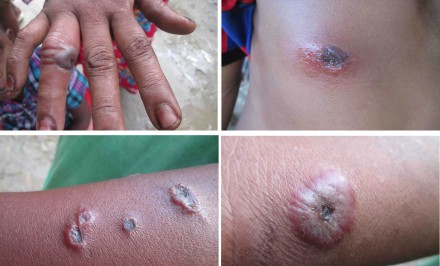 শাহজাদপুরে আবারও মানব দেহে অ্যানথ্রাক্সঃ ১৩ জন আক্রন্ত