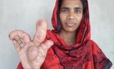 এবার তাড়াশে নারীর হাতে বিরল রোগের সন্ধান