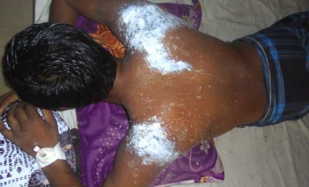 বেলকুচিতে এসিড দগ্ধ এক যুবক