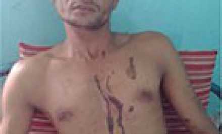 হত্যা মামলা থেকে রেহাই পাওয়ার কৌশল শাহজাদপুরে এসিড দগ্ধর ঘটনা সাজানো নাটক