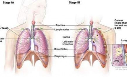 জেনে নিন কি কারণে হতে পারে স্তন ক্যান্সার !