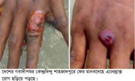 শাহজাদপুরে আবারও মানবদেহে পশু রোগ এ্যানথ্রাক্স ছড়িয়ে পড়েছেঃ আক্রান্ত ১১ জন